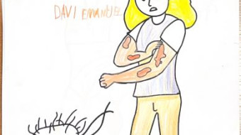 Campanha nacional Todos contra a Hanseníase - Foz do Iguaçu