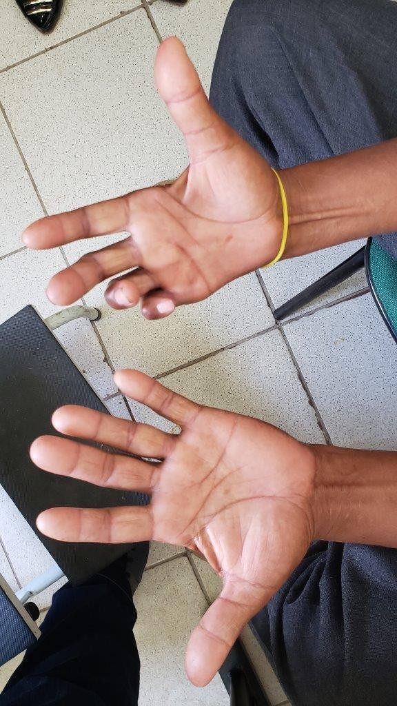 Incapacidade física causada pela hanseníase em paciente do Pará