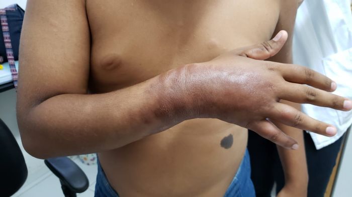 Assunto: Falta de poliquimioterapia (PQT) no Brasil para os pacientes de hanseníase