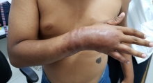 Falta medicação para pacientes de hanseníase no Brasil